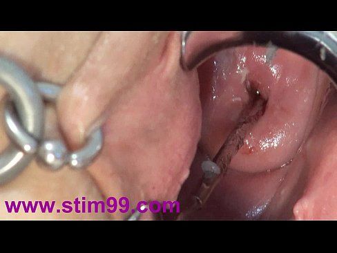 Cervix deep penetration